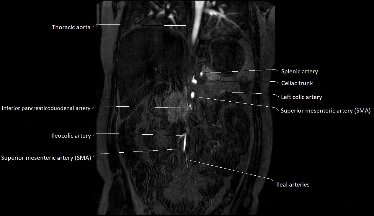 MRA Abdomen coronal anatomy image 11.webp